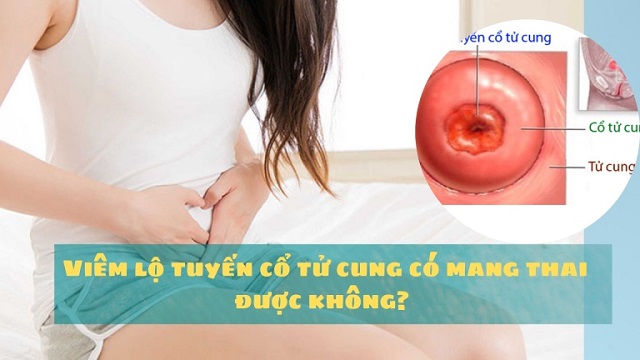 Read more about the article Viêm lộ tuyến cổ tử cung có mang thai được không? 